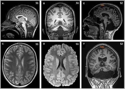 Stroke-Like Episodes in PMM2-CDG: When the Lack of Other Evidence Is the Only Evidence